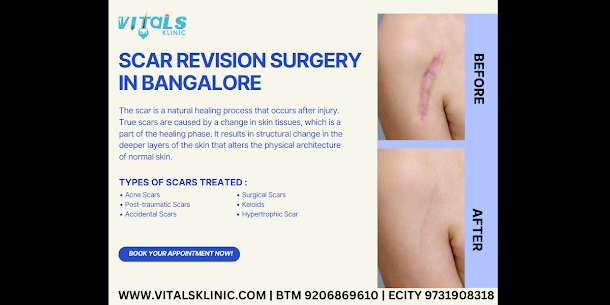 Scar Revision Surgery in Bangalore – 2026